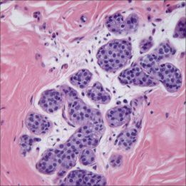 Figure 1: Atypical lobular hyperplasia demonstrating solid sheets of proliferating, dis-cohesive, monomorphic epithelial cells imbued with pale pink cytoplasm, uniform ovoid nuclei and indistinct nucleoli [5].