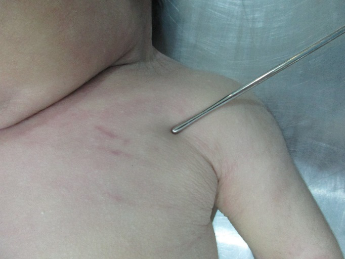 Figure 1: Two Linear Abrasions on the Left Side of the Chest.