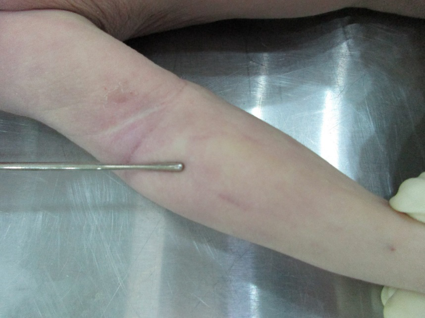 Figure 2: Linear Abrasion on the Right Forearm.