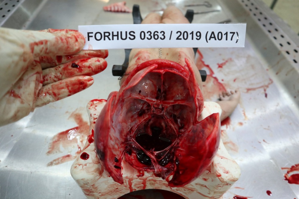 Figure 4: Presence of Subdural Haemorrhage.