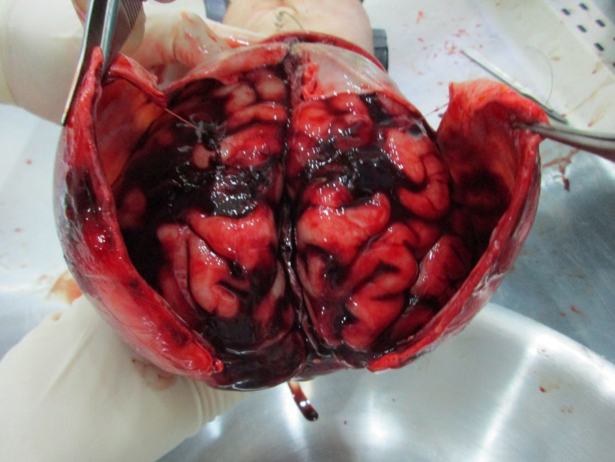 Figure 5: Subarachnoid Haemorrhage on Both Cerebral Hemispheres.
