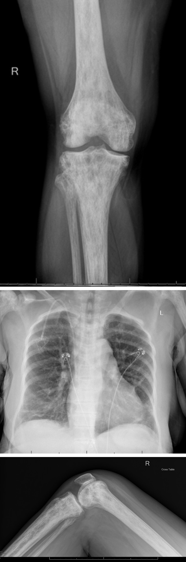 Figure 1: Chest X-ray of the patient.
