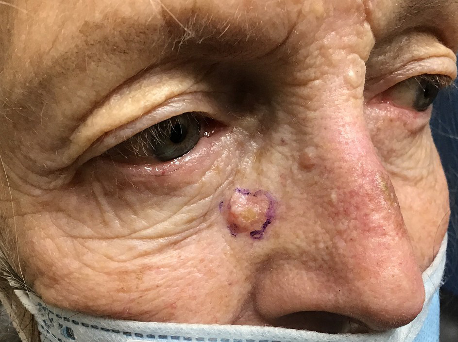 Figure 1: Biopsy proven basal cell carcinoma on right lateral sidewall.