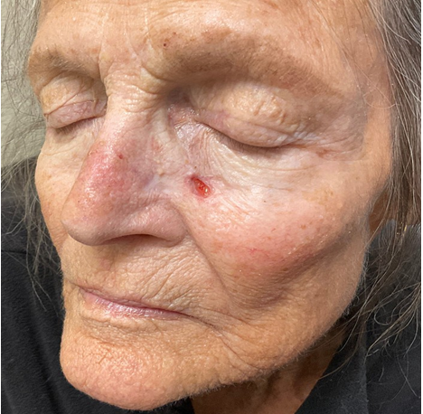 Figure 11: Three week follow up after initial application of amniotic graft.