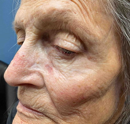 Figure 12: Five week follow up after initial application amniotic graft.