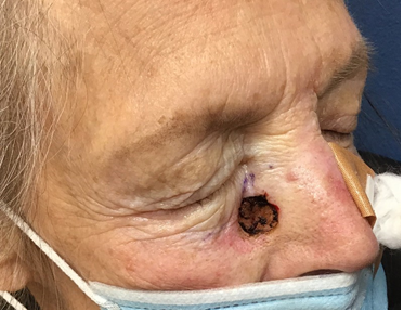 Figure 2: Defect on right lateral nasal sidewall after Mohs surgery.