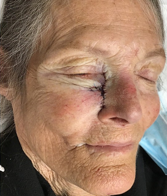 Figure 3: Defect on right lateral nasal sidewall after adjacent tissue transfer reconstruction.