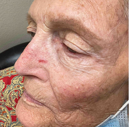Figure 4: Biopsy proven basal cell carcinoma on left nasal sidewall.