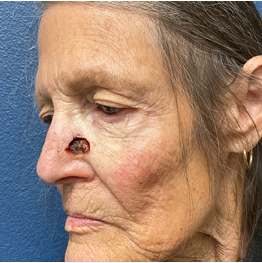 Figure 5: Left nasal sidewall defect after Mohs surgery.
