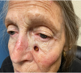 Figure 6: Biopsy proven basal cell carcinoma on left medial cheek.