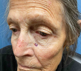 Figure 7: After thoroughly discussing the alternatives, it was decided to use an amniotic graft to help increase the rate of wound closure through secondary intention. The graft was applied, along with 2% mupirocin ointment, adaptic, telfa, tegaderm, and brown tape in order to secure the graft. The patient was instructed to keep the dressing dry and to leave in place for 7 days until follow up.