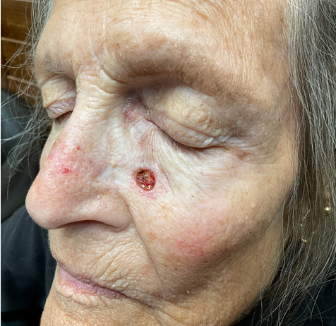 Figure 9: Seventeen month postoperative result healed through secondary intention and collagen powder.