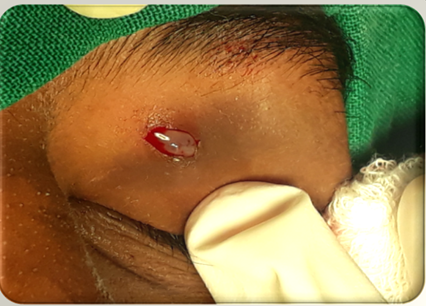 Figure 2: Intra operative cystic appearance.