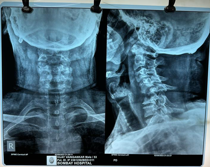Figure 1: X rays depicting – Complete destruction of C5 body, C6 superior end plate destruction with partial destruction of C4 causing kyphosis.