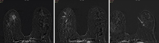 Figure 11: a) Post contrast dynamic MRI axial view showing a contrast enhancing spiculated lesion in the right breast corresponding to the mammographic image. HPE confirmed a tubular carcinoma. b) In addition, there were other areas of contrast enhancement in the right breast. Histopathology of these lesions confirmed an invasive lobular carcinoma. c) The left breast enhancing lesion was reported to be an invasive ductal carcinoma.