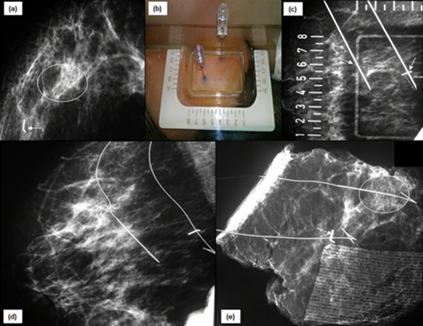 Figure 14: Hookwire bracketing: (a) Mammogram of right breast shows tumor marker clip (arrow) at the site of mass which has resolved post chemotherapy. There is another cluster of suspicious microcalcification in same quadrant (circle). (b) Both the clips and grouped microcalcifications are targeted using alphanumeric grid and two hookwires have been placed (arrows in c). This procedure is known as “hookwire bracketing.” The position of wires is confirmed on MLO view (d). Subsequently performed specimen mammogram (e) demonstrates and ensures removal of marker clip (arrow), microcalcifications (circle) and hookwires.