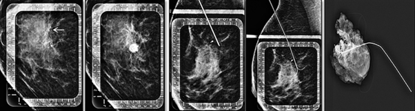 Figure 15: Tumor localization using hook wire (left to right): the tumor site is identified on mammogram (white arrow) and targeted based on alphanumeric compression plate followed by insertion and deployment of the hookwire. Radiograph of surgical specimen is then obtained which confirmed removal of clip as well as hookwire in toto.