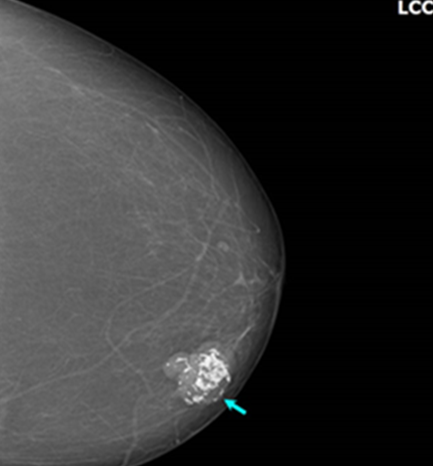 Figure 7: Benign coarse “popcorn” calcification.