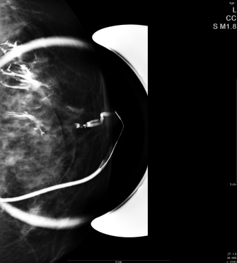 Figure 9: Mammographic spot image during a ductogram shows contrast (white) within the catheter and branching ductal system.