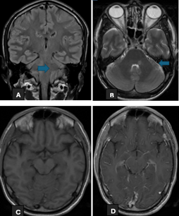 Figure 1: A 38 years old gentleman presented with persistent headache. On examination he had positive signs of miningism. MRI head (Figure A+B) show vertical hyperintense focus involving posterior left hemi-pons on T2 and FLAIR sequences. (Figure C+D) show leptomeningeal enhancement. Patient underwent lumbar puncture; CSF Detailed Report was highly suggestive of infection. Bio-Fire meningitis panel was sent and it detected Listeria Monocytogenes.