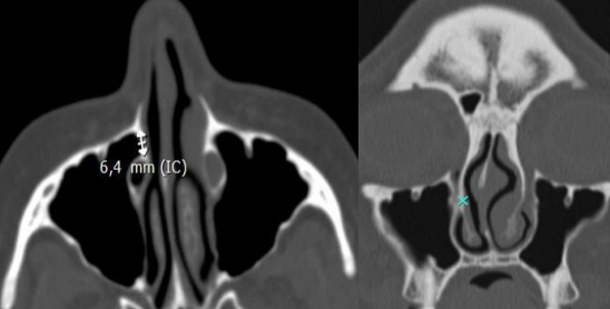 Figure 1: Measurement on Preoperative Tomography of the Distance between the Posterior Limit of the Frontal Process of the Maxilla at its Junction with the Anterior Wall of the Sinus and the Lacrimal Nasolacrimal Duct.