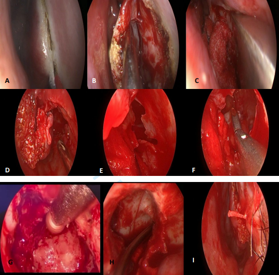Figure 2: Prelacrimal Endonasal Approach to the Maxillary Sinus with Endoscopes. A: Incision with Cautery 3mm Anterior to the Inferior Turbinate; B: Subperiosteal Dissection; C: Prelacrimal Maxillary Osteotomy with Chisel; D,E: Prelacrimal Maxillary Window; F: Resection with Forceps of an Inverted Papilloma with Anteroinferior Implantation; G: Milling of the Maxillary Sinus through the Prelacrimal Window; H: Endoscopic View of the Anterior, Inferior, an Lateral Sectors of the Maxillary Sinus After Milling the Site of Inverted Papilloma Implantation; I: Suturing of the Inferior Turbinate.