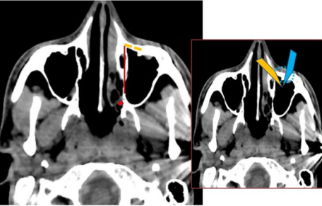 Figure 3: Extended Endonasal Approaches to the Maxillary Sinus: A: Red Line: Medial Maxillectomy, Yellow Line: Endoscopic Denker; B: Endoscopic View through the Prelacrimal Approach (Yellow) and through Anterior Maxillary Sinusotomy (Light Blue).