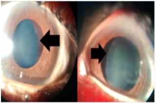 Figure 1: temporal subluxation of lens.