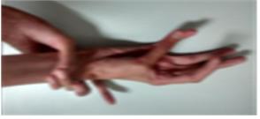 Figure 2: Positive Wrist (Walker) sign.