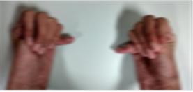 Figure 3: Positive Thumb (Steinberg) sign.