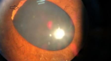 Figure 4: Infero-temporally displaced lens OD.