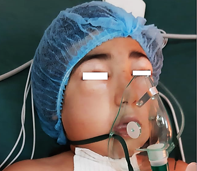 Figure 1: Spongy swelling of the eyelids on admission.