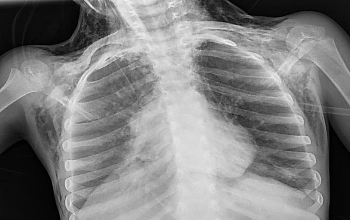 Figure 2: Frontal chest x-ray showing significant subcutaneous emphysema with pneumo-mediastinum.