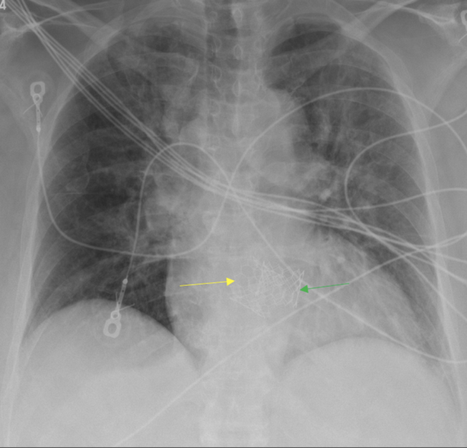 Figure 11: AP chest radiograph demonstrates both aortic (orange arrow) and mitral (blue arrow) prosthetic valves in adequate position.