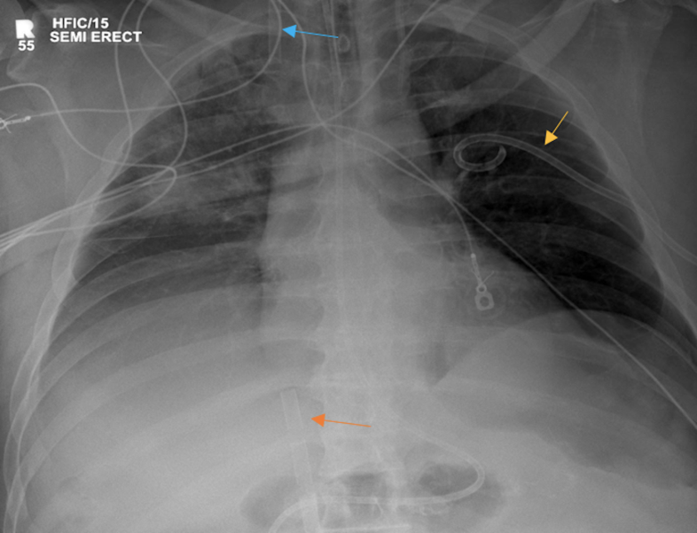 Figure 19: PA chest radiograph showing Mitraclip (orange arrow).