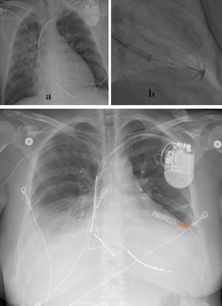 Figure 25: AP chest radiograph demonstrates ECMO Veno- venous cannulas; right IJV (blue arrow) and IVC (orange arrow). A thoracic pigtail catheter (yellow arrow) is present on the left side.
