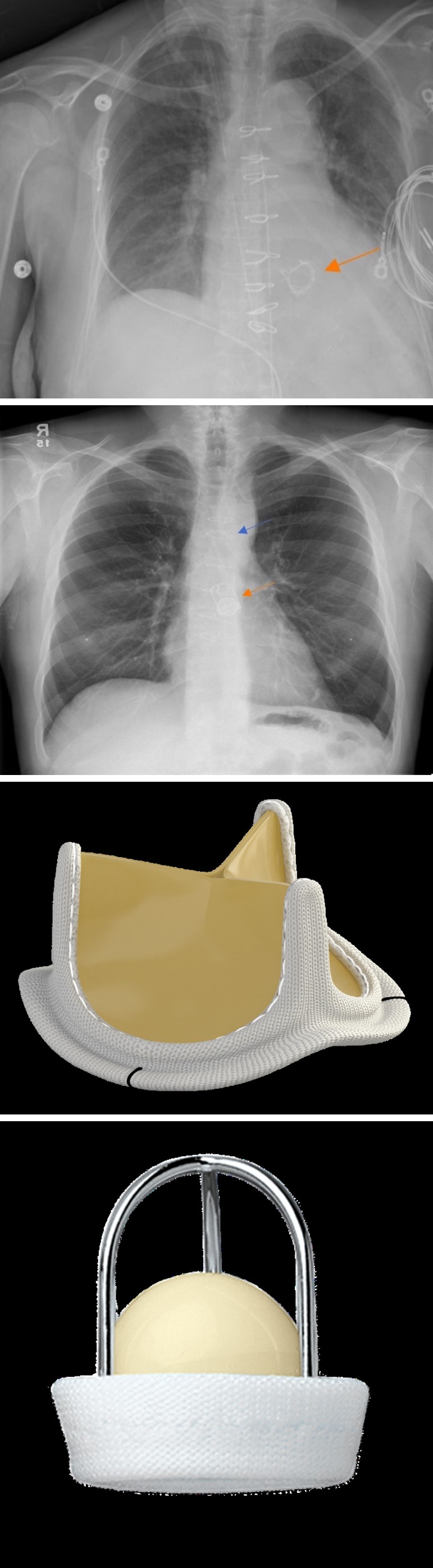 Figure 5: Prior sternotomy, PA chest radiograph demonstrates temporary epicardial electrodes (orange arrow) in place. Tricuspid annuloplasty is also noted (blue arrow).