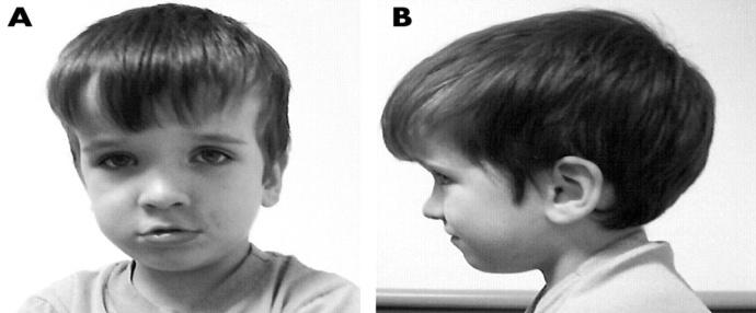 Figure 4: Macrocephaly in an autistic child. Neuro developmental differences were investigated with Voxel-based morphometry (VBM) which is a neuro imaging technique that allows the study of focal differences in brain anatomy; it showed in autistic individuals that there are considerable anatomical differences in many brain areas. One of these areas that showed increase in grey matter size was the anterior part of temporal lobe. Temporal lobe in the left hemisphere was noticed to be larger to the rest of the brain regions and that was associated with more social, but not repetitive, symptoms. The temporal lobe was drawing much attention in further studies because it was found to be linked in high level cognitive development like in mentalizing or in the semantic processing (deep memory processing) either in childhood, adolescence or early adulthood [13]. These findings were further studied using fMRI and the results suggest the role of the anterior temporal lobe in moderating social impairments in autistic individuals, a study that was conducted by Nature Reviews Neuroscience and was published in 2007. Other researches revealed that the grey matter increases in size in the prefrontal brain cortex especially in the pre-central and post-central gyri. This neuro developmental difference could be the cause in atypical motor responses, fine motor progression and visuo-motor adaptation observed in autistic people. Christine found that there are differences in the basal ganglia and thalamus volumes in autistic individuals compared to neurotypicals. Also, in autistics there are differences in frontostriatal systems starting in childhood and continuing into adulthood and the severity of the repetitive behaviours noticed in autistics are associated with anatomical differences in frontal brain regions.