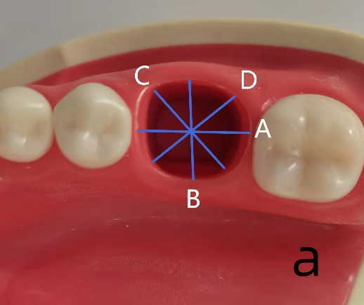Figure 2: 5. According to the findings of a previous investigation [13], the horizontal resorption of the alveolar bone on the buccal aspect exhibited the following percentages: 19.4 ± 9.4% at the mesial point, 39.1 ± 10.4% at the midpoint, and 20.3 ± 10.7% at the distal level, within a six-month period post-extraction of a single tooth. Taking into account this data, alongside the acquired gingival contour information of the mandibular first molar, the lengths of lines B, C, and D were reduced by 20% in order to design a modified anatomical healing abutment. The fabrication of this healing abutment involved CAD-CAM casting of a base made of grade 5 titanium. 6. Make a 3D digital model intraoral scan impression: the digital model is the transverse section of the modified anatomic healing abutment for the mandibular first molar was designed in the form of an round rectangle (Figure 3a). 7. The design parameters for the modified healing abutments are presented in Table 1. The lateral profile of each modified anatomic healing abutment by Computer aided design equipment and software design (EXOCAD2019, Exocad, Germany) (Figure 3b). 8. Placing the modified anatomic healing abutments designed in the model (Figure 3c). A central screw hole was positioned within each modified anatomic healing abutment. 9. Send the design for the CAD-CAM metal modified healing abutment for printing to 3D numerical control processing equipment (B51, Shenzhen Colide Medical Technology Co., LTD., China) 10.	 Proceed with the CAD-CAM fabrication Figures 4a & b these modified healing abutments were fabricated using a grade 5 titanium (JZ-V98, Xi ‘an Jiuzhou Biomaterials Co., LTD., China).
