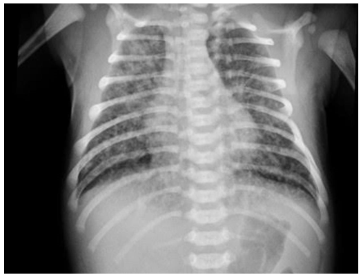 Figure 8: Sepsis.
