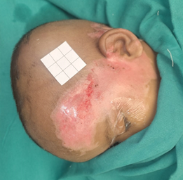 Figure 4: Partially healed wound after 7 days.