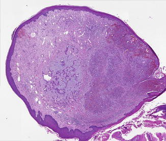 Figure 1: Composite hemangioendothelioma composed of variable proportion of spindle cell, capillary and cavernous haemangioma. Epithelioid endothelial cells exhibit a vacuolated, pseudo-lipoblastic countenance.