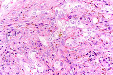 Figure 2: Composite haemangioendothelioma delineating a variable proportion of cavernous, capillary and spindle cell haemangioma component. Epithelioid endothelial cells exhibit a vacuolated, pseudo-lipoblastic countenance.