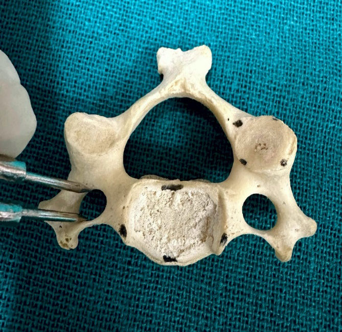 Figure 4: Bar chart showing the Length and Height of the Uncinate Process on the Right side of Typical Cervical Vertebrae.