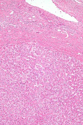 Figure 1: Hepatocellular adenoma delineating aggregates of hepatocyte cell plates imbued with abundant eosinophilic cytoplasm and uniform nuclei surrounded by normal hepatic parenchyma. Foci of cytological atypia or infiltration of portal tracts is absent [5].