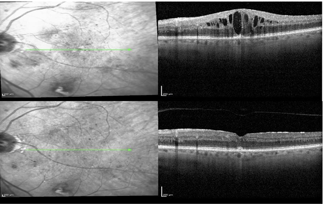 Figure 3: Mean standard deviation of central macular thickness at time 0, time 4 months and time 6 months.