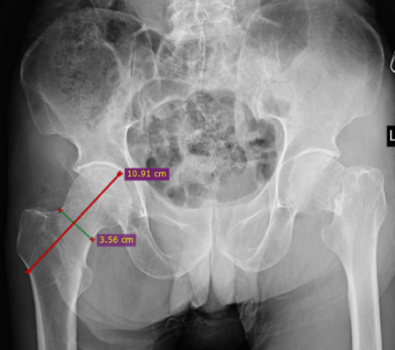 Figure 2: Measurement of Femoral Neck Axis.