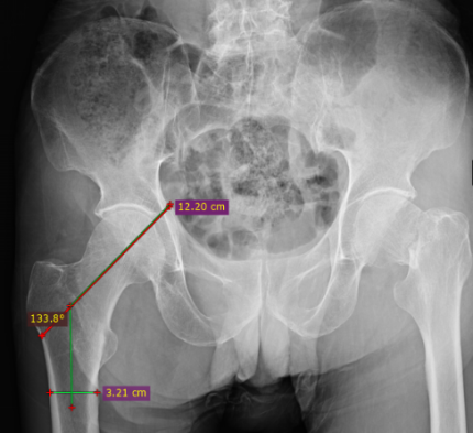 Figure 3: Measurement of Neck Shaft Angle.