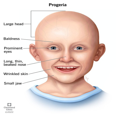 Figure 1: Facial features of Progeria.