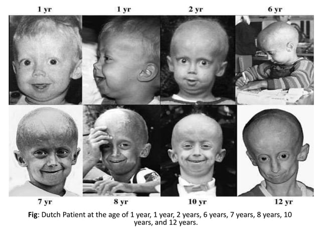 Figure 3: Dutch Patient at the age of 1year, 2year, 6year, 7year, 8year, 10 year and 12 years.